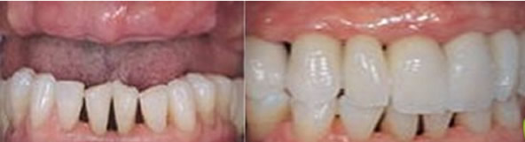 多颗牙缺失怎么办 成都瑞安口腔种植牙技术修复效果就很棒