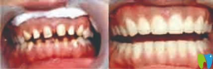 重庆贝尔口腔牙齿修复案例效果图