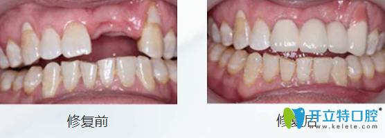 詹统英两颗牙缺失种植案例前后对比图