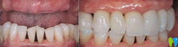 多颗牙缺失种植术后效果对比图