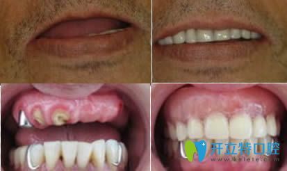 重庆贝尔口腔重庆贝尔口腔怎么样？来看种植牙和牙齿矫正的效果及技术