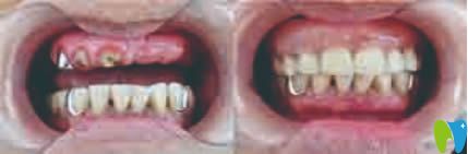 重庆贝尔口腔种植牙案例图
