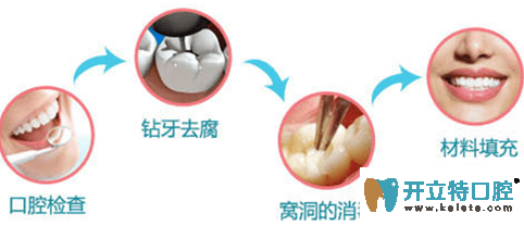 光固化树脂补牙步骤