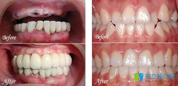 大众口腔半口牙缺失种植+牙齿矫正前后效果对比图