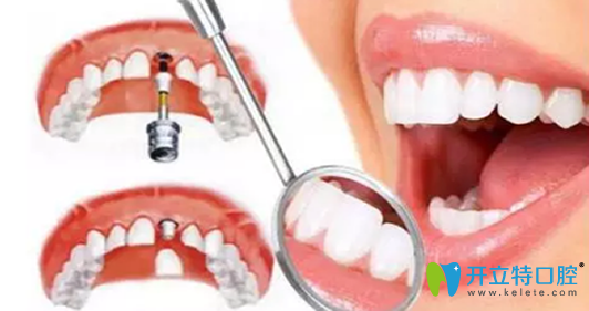 如果是高级植牙技术，牙医还会建议亲属不要植牙吗