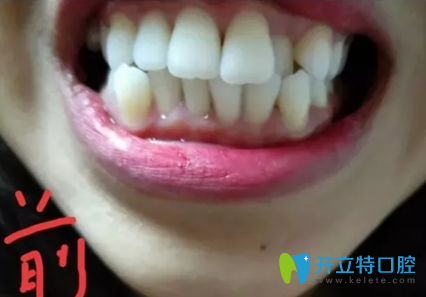 在北京顺德口腔做牙齿正畸前照片