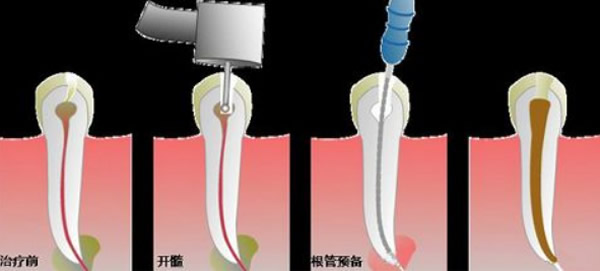 根管治疗后牙疼怎么办 看北京拜博口腔正畸医生的解决方法