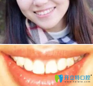 我在西安美奥口腔做隐适美牙齿矫正一年的的效果 我在西安美奥口腔做隐适美牙齿矫正一年的的效果