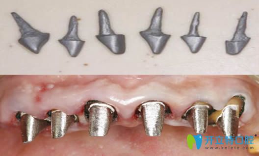 金属桩和纤维桩的区别有哪些？牙齿桩核冠修复技术解析