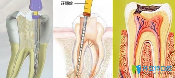 根管治疗对技术要求很高