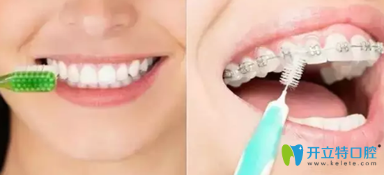 传统牙套和隐形矫正清洁难易程度对比
