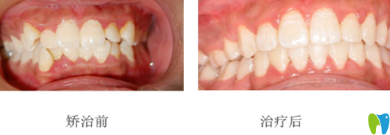一例单侧拔牙病例的正畸治疗案例（杭州拜博口腔）