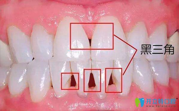 矫正牙齿导致的黑三角