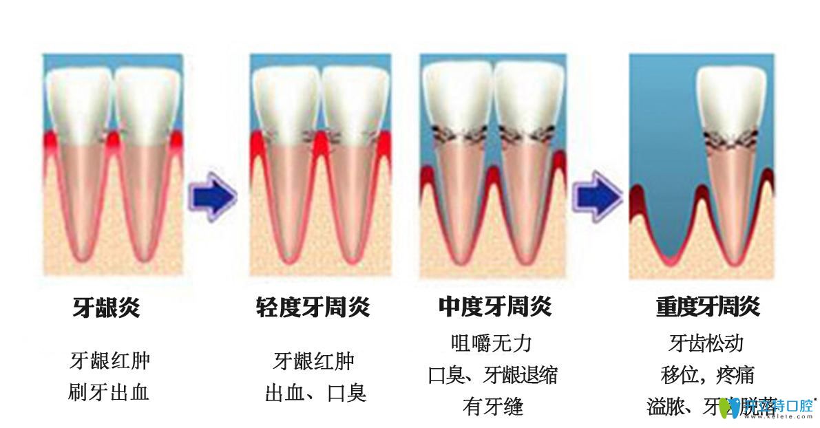 导致牙齿黑三角的6大原因