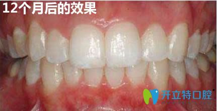 在上海马泷齿科做完隐适美牙齿矫正12个月的效果