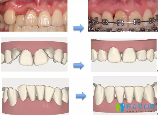 牙齿矫正导致黑三角的原理图