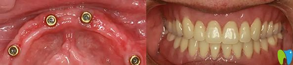 瑞尔口腔种植牙案例效果对比图