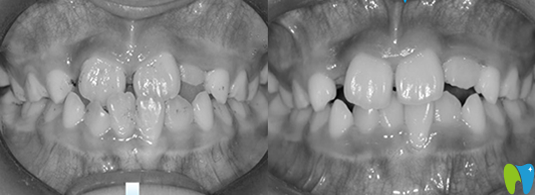 金琴口腔许医生替牙期的“地包天”小朋友牙齿正畸案例