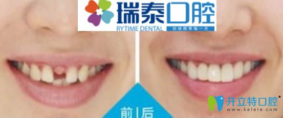 重庆瑞泰35岁顾客单颗牙缺失种植案例图