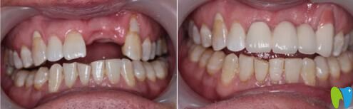 健齿口腔阎照勇医生种植牙效果案例