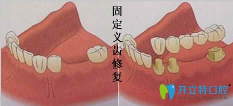 南京美奥口腔固定义齿修复图