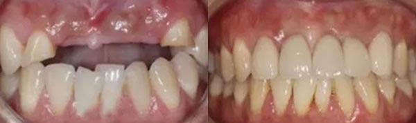 烤瓷牙牙龈萎缩怎么办 成都瑞尔口腔种植牙修复技术就不错