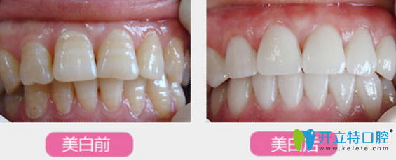 WY10（英国威十）美齿技术美牙案例