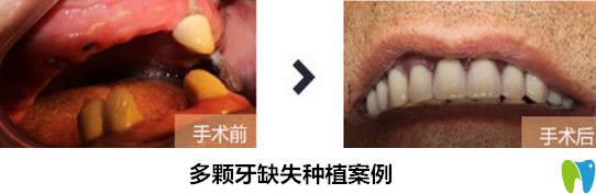 在成都华美牙科做多颗牙缺失种植案例