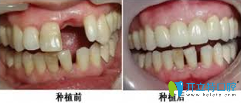 郑州精益口腔种植牙前后效果对比图 郑州精益口腔种植牙前后效果对比图