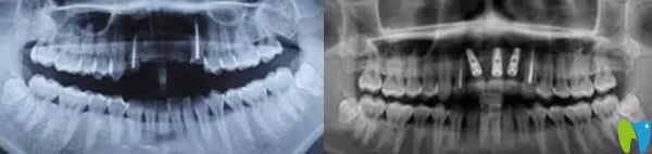 瑞尔口腔郝亦工医生种植牙方案