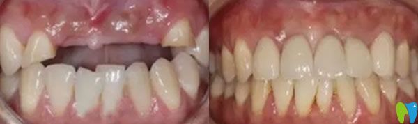 成都瑞尔口腔牙齿种植前后效果图 成都瑞尔口腔牙齿种植前后效果图