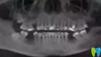 在成都华美口腔做种植牙前拍摄的口腔CT片