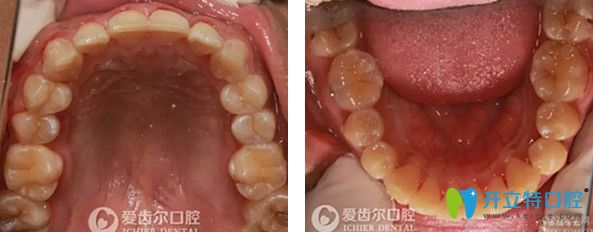 自锁托槽矫正牙齿一年后 自锁托槽矫正牙齿一年后