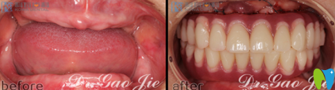 杭州科瓦齿科高杰全口牙种植案例图