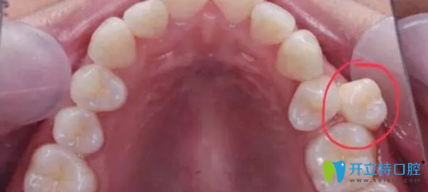 多生牙会排挤正常的牙齿