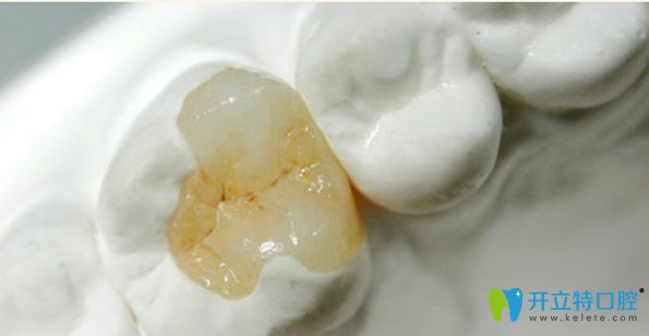 嵌体是在口外牙模上由专业医生制成的 嵌体是在口外牙模上由专业医生制成的