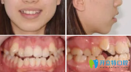  记录李女士26岁在成都亚非口腔做牙齿矫正的前后对比照片