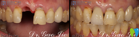 杭州科瓦口腔高杰单颗牙种植前后对比图