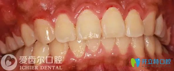 武汉爱齿尔口腔矫正牙齿6个月效果 武汉爱齿尔口腔矫正牙齿6个月效果