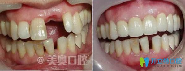 杭州美奥口腔单颗牙缺失种植牙前后对比图