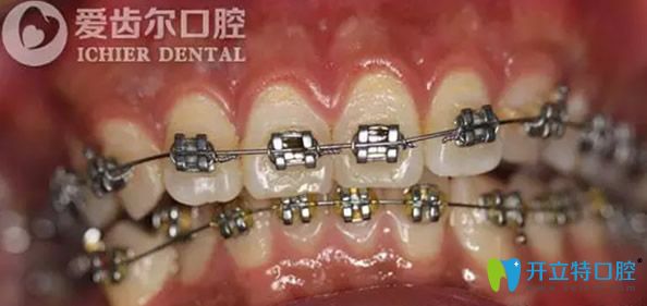 刚带上自锁托槽牙套 刚带上自锁托槽牙套