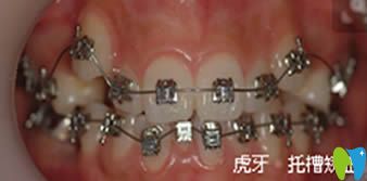 西安康洁口腔门诊牙齿金属托槽矫治中图片