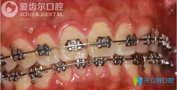 自锁托槽矫正牙齿两个月后 自锁托槽矫正牙齿两个月后