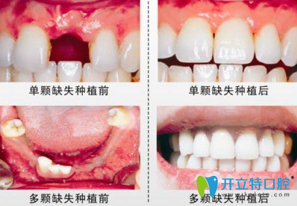 杭州科瓦齿科种植牙前后效果对比图 杭州科瓦齿科种植牙前后效果对比图