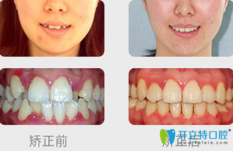 杭州科瓦口腔牙齿矫正前后效果对比图