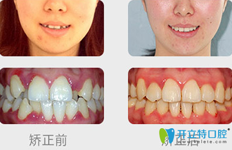 杭州科瓦口腔牙齿矫正前后效果对比图 杭州科瓦口腔牙齿矫正前后效果对比图