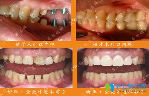 崔建水医生真人牙齿种植及牙齿矫正修复案例