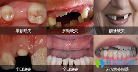 成都唐牙科各种牙齿缺失现象图 成都唐牙科各种牙齿缺失现象图