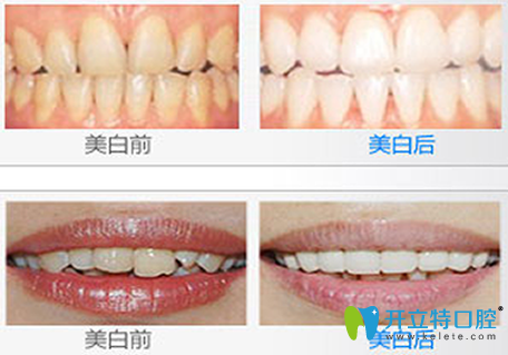 深圳中信口腔牙齿美白前后效果对比图