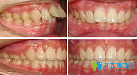 深圳中信健康口腔牙齿矫正前后效果对比图